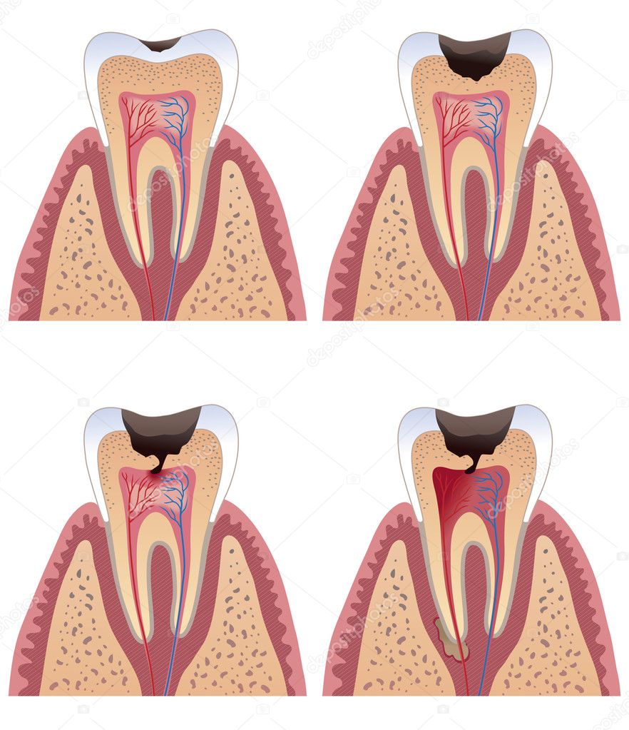 Stages Of Caries