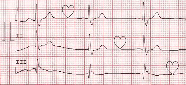 ECG with hearts