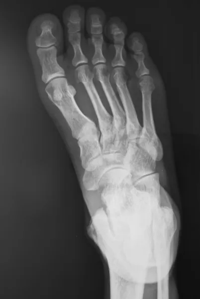 The health of the feet of X figure