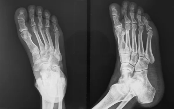 The injured foot of X-ray figure