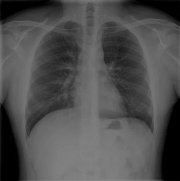 X-Rays of male chests