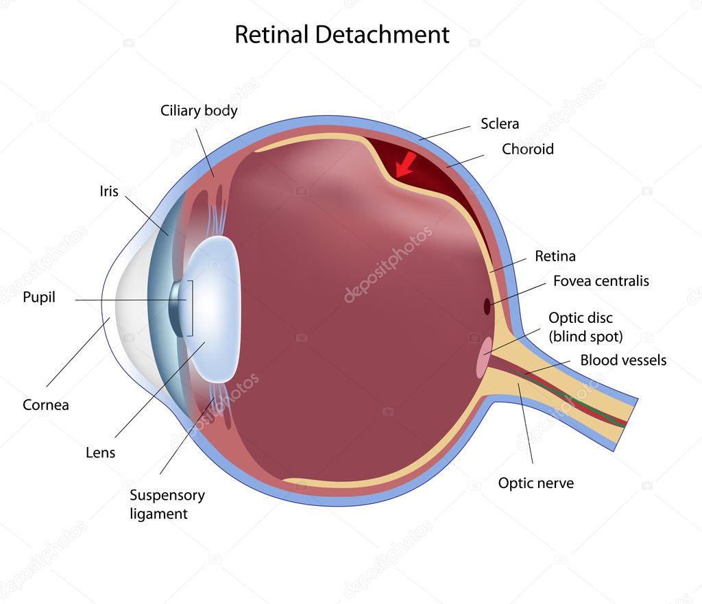 Retina Detached