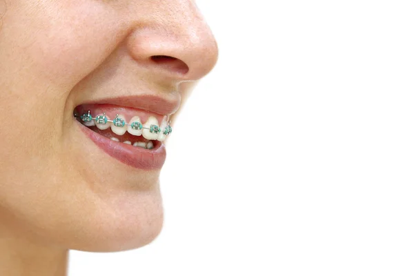 Stock Photo: Teeth Braces. | Add to Lightbox | Big Preview teeth braces. Stock Photo: Teeth Braces. | Add to Lightbox | Big Preview
