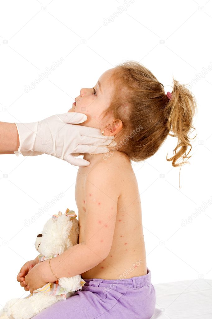 Little Pox