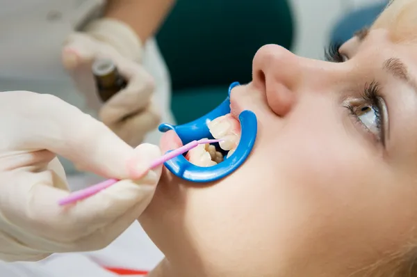 Dental procedure of teeth protecting — Stock Photo, Image