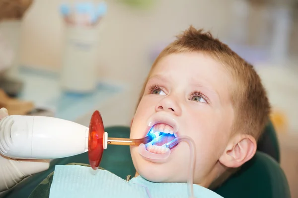 Zahnfeilung von Kinderzähnen durch UV-Licht — Stockfoto
