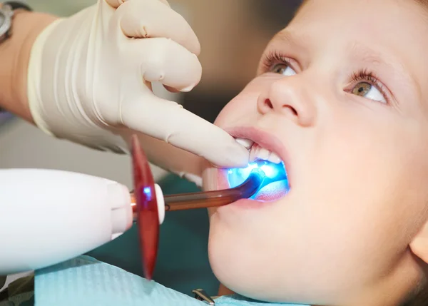 Archiviazione dentale dei denti dei bambini mediante luce ultravioletta — Foto Stock