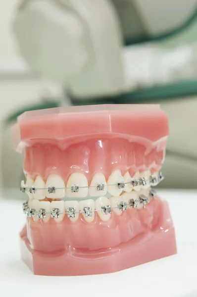 Modello di apparecchio per mascelle dentali inferiori e superiori — Foto Stock