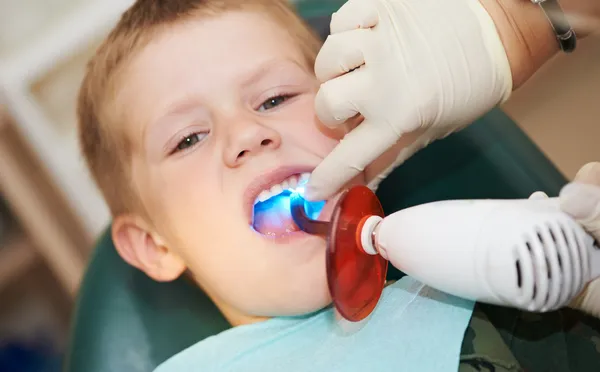 Dental inlämning av barn tand av ultraviolett ljus — Stockfoto