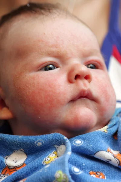 Il bambino ha eczema — Foto Stock
