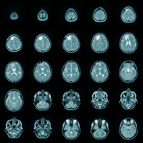 stock image Magnetic risonance image MRI of a human brain