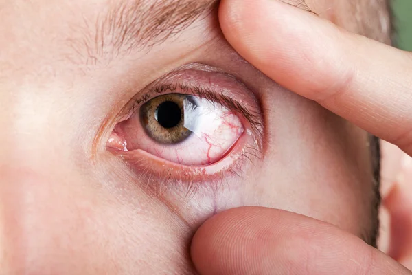 Αίμα τριχοειδή ανθρώπινο μάτι Εικόνα Αρχείου
