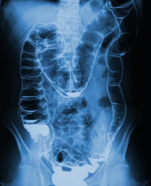Röntgen des Oberkörpers — Stockfoto