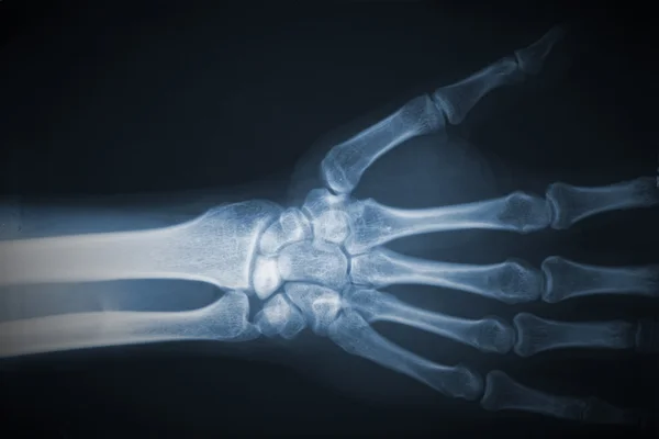 Rayos X de mano — Foto de Stock