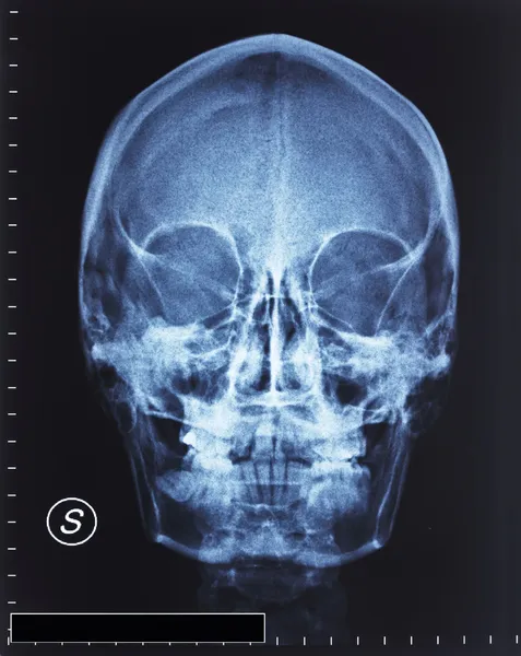 頭蓋骨の x 線 — ストック写真