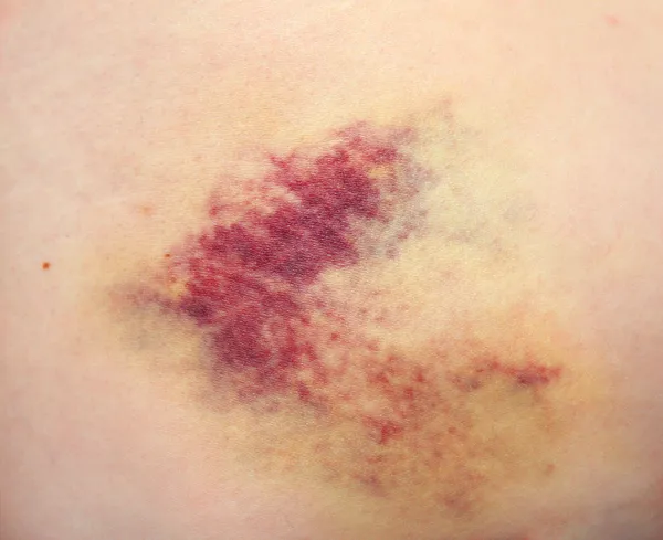 Bruise — Stock Photo, Image