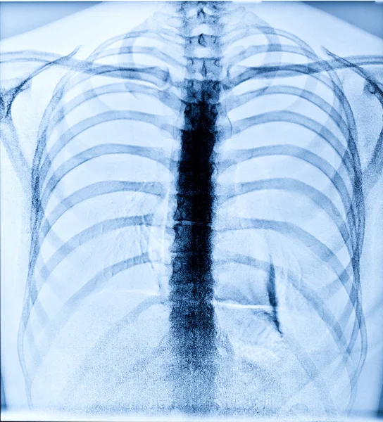 人間の胸のX線画像 — ストック写真