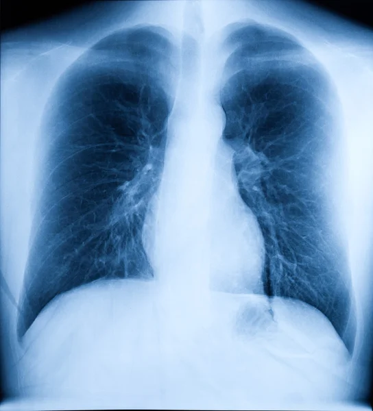 Imagen de rayos X del pecho humano — Foto de Stock