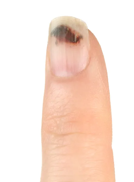 Doigt avec ongle meurtri (hématome sous-bungual) ) — Photo