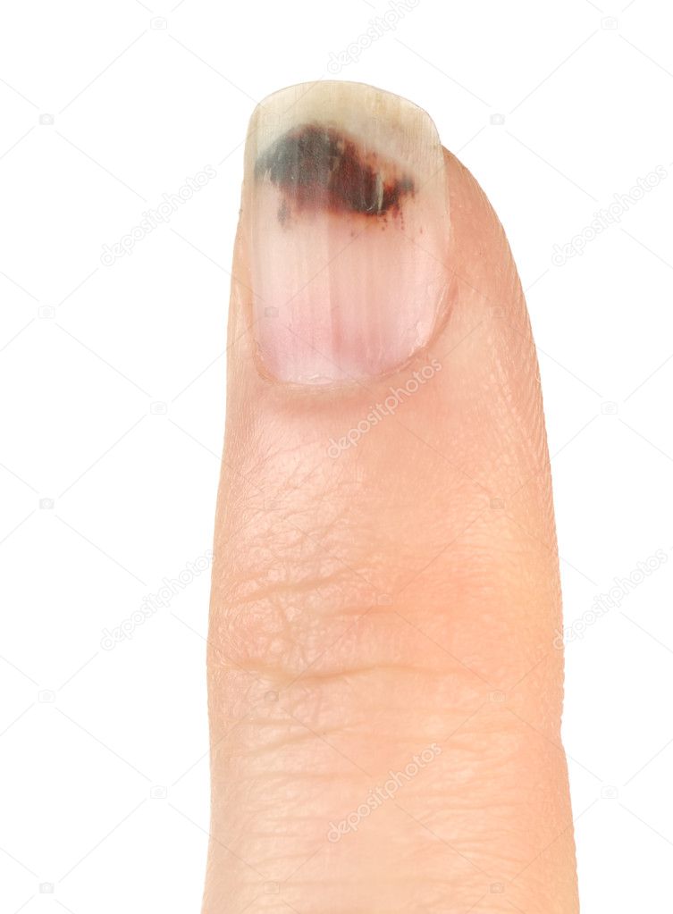 Finger with Bruised Nail (Subungual Hematoma)