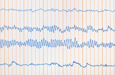 Elektrokardiyogram EKG