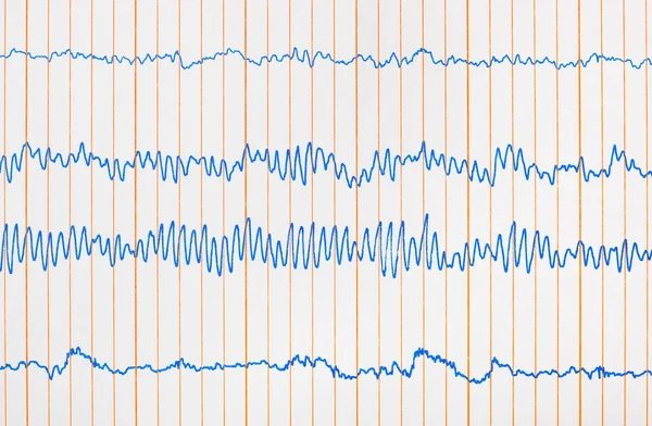 Électrocardiogramme ecg — Photo