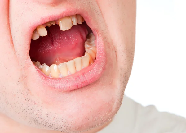 Молодой человек со сломанным зубом — стоковое фото