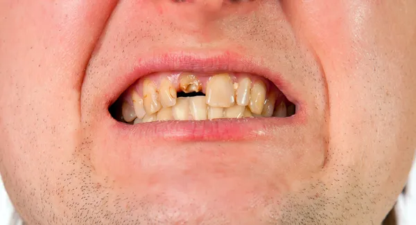 Mladý muž ústa s zlomený zub — Stock fotografie