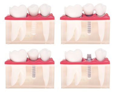 Implant dental model clipart