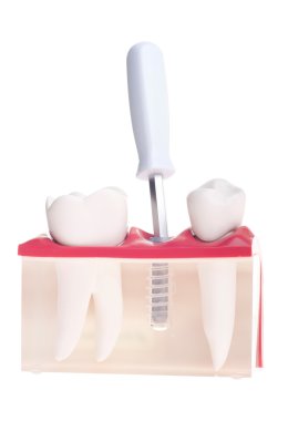 Implant dental model clipart