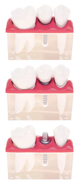 Implant diş modeli — Stok fotoğraf