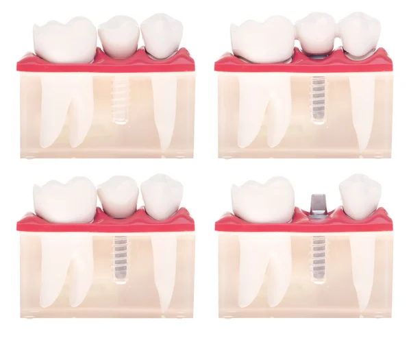 Implantáty zubní modelu — Stock fotografie