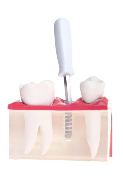Implantáty zubní modelu — Stock fotografie