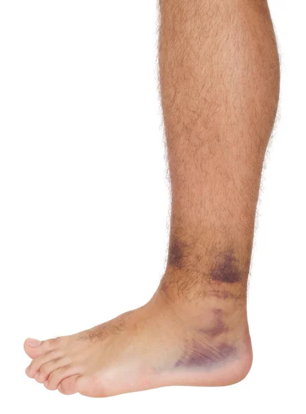Torção do tornozelo — Fotografia de Stock