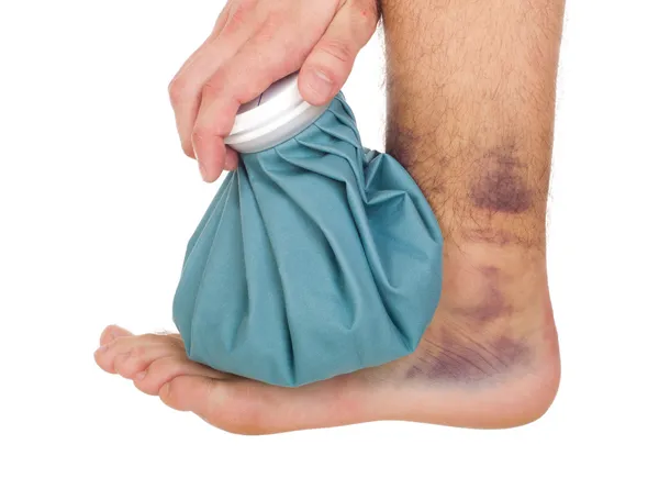 Icing a sprained ankle — Stock Photo, Image