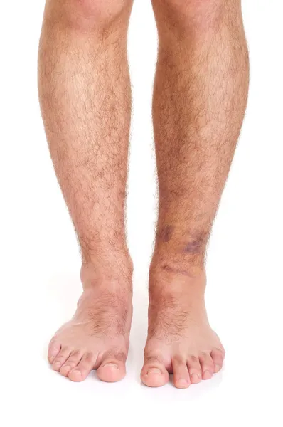 Torção do tornozelo — Fotografia de Stock