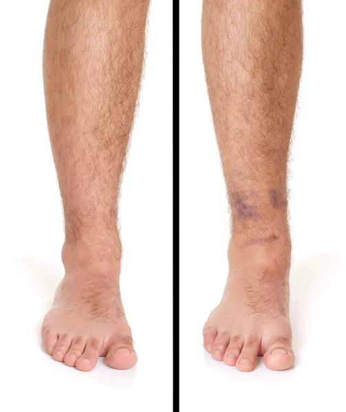 Ankle Sprain — Stock Photo, Image