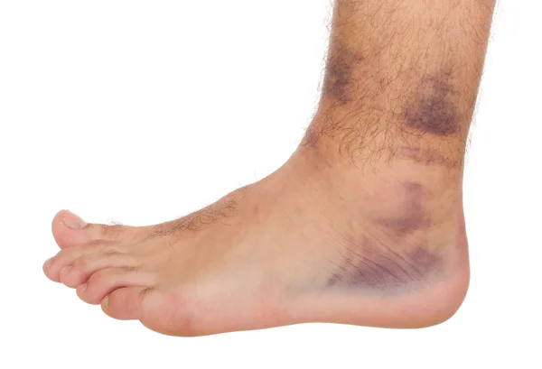 Ankle Sprain Stock Image