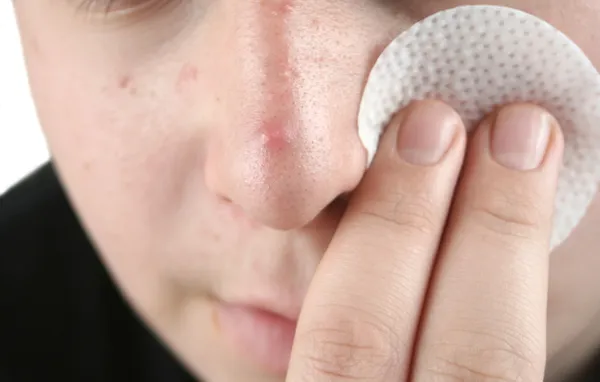 Boy cleansing face with acne pad — Stock Photo, Image