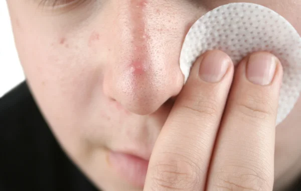 Jongen zuivering gezicht met acne zeem Stockafbeelding