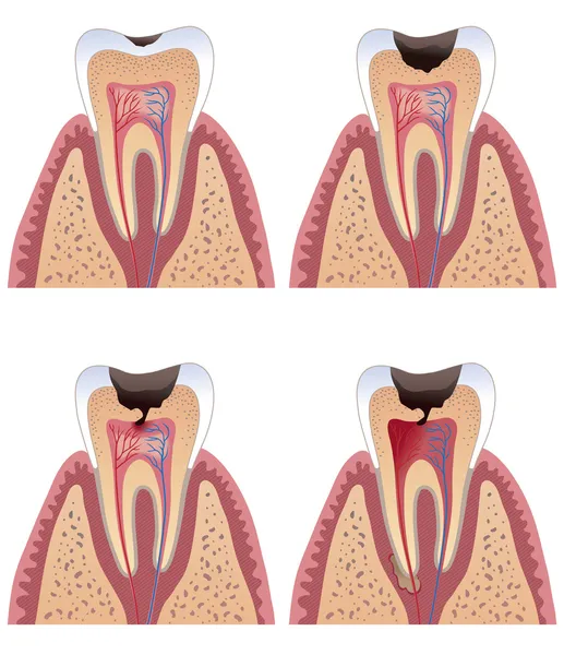 Caries stages — Stock Vector