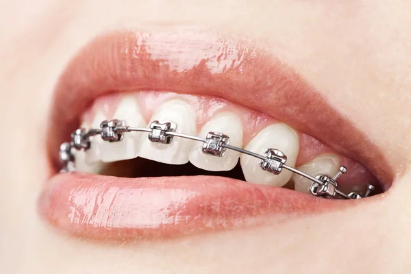 Зубы с брекетами — стоковое фото