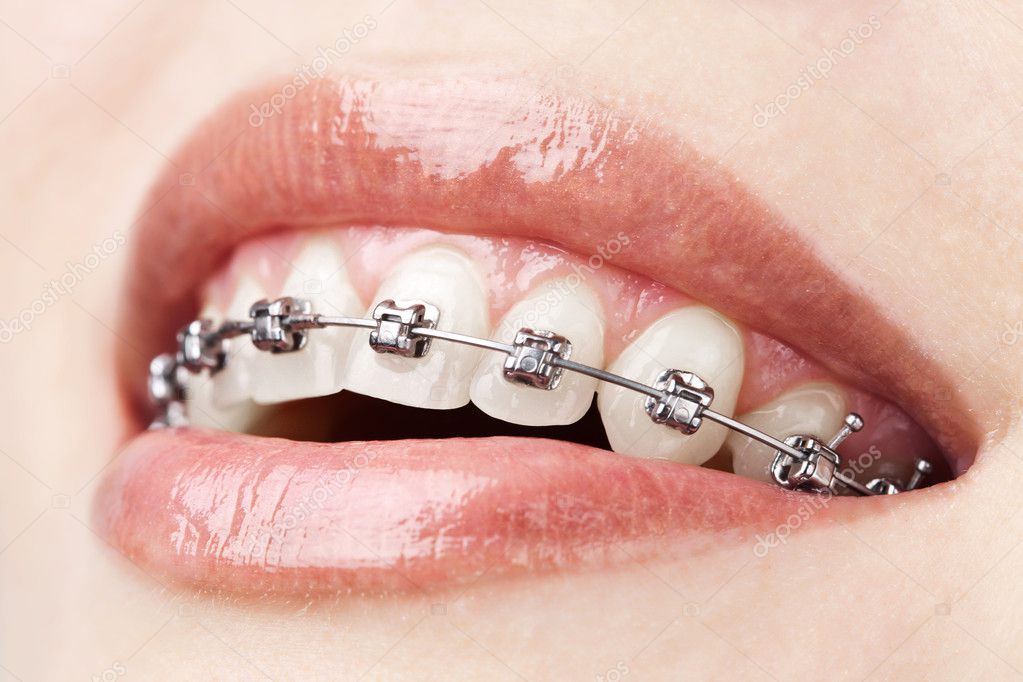 Odontología brackets fotos de stock, imágenes de Odontología brackets sin  royalties | Depositphotos