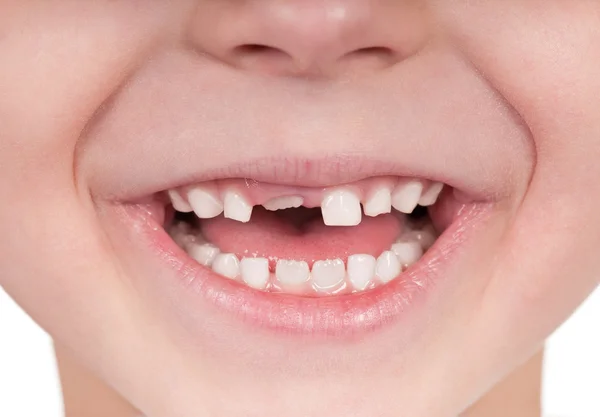 Toothless smile — Stock Photo, Image
