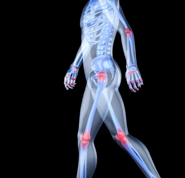 Skelett des Mannes mit den Schmerzzentren der Gelenke — Stockfoto