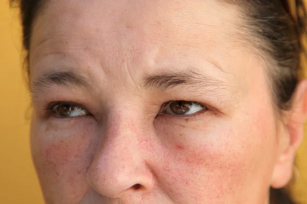 Obrzęk oczu i twarzy do alergii — Zdjęcie stockowe