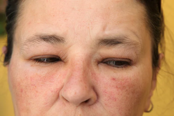 Olhos inchados e rosto para alergia — Fotografia de Stock