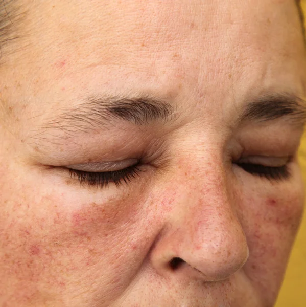 Oteklé oči a tvář pro alergii — Stock fotografie