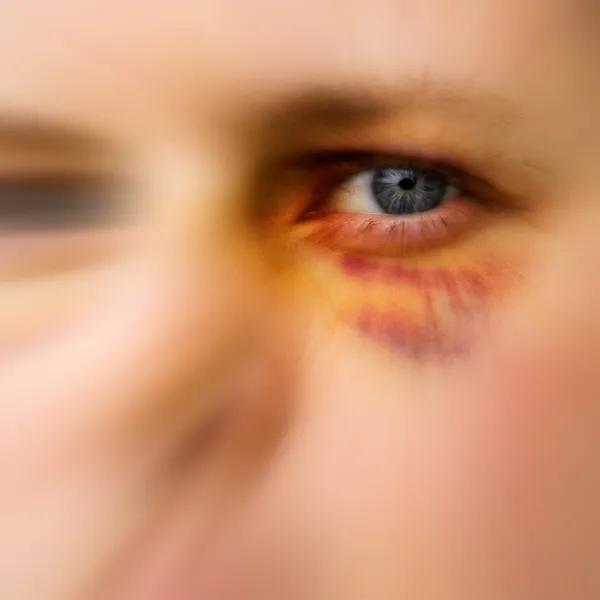 Streszczenie podbite oko — Zdjęcie stockowe