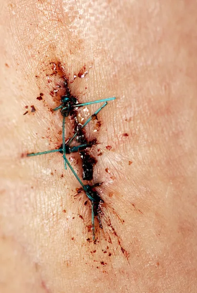 Points de suture — Photo